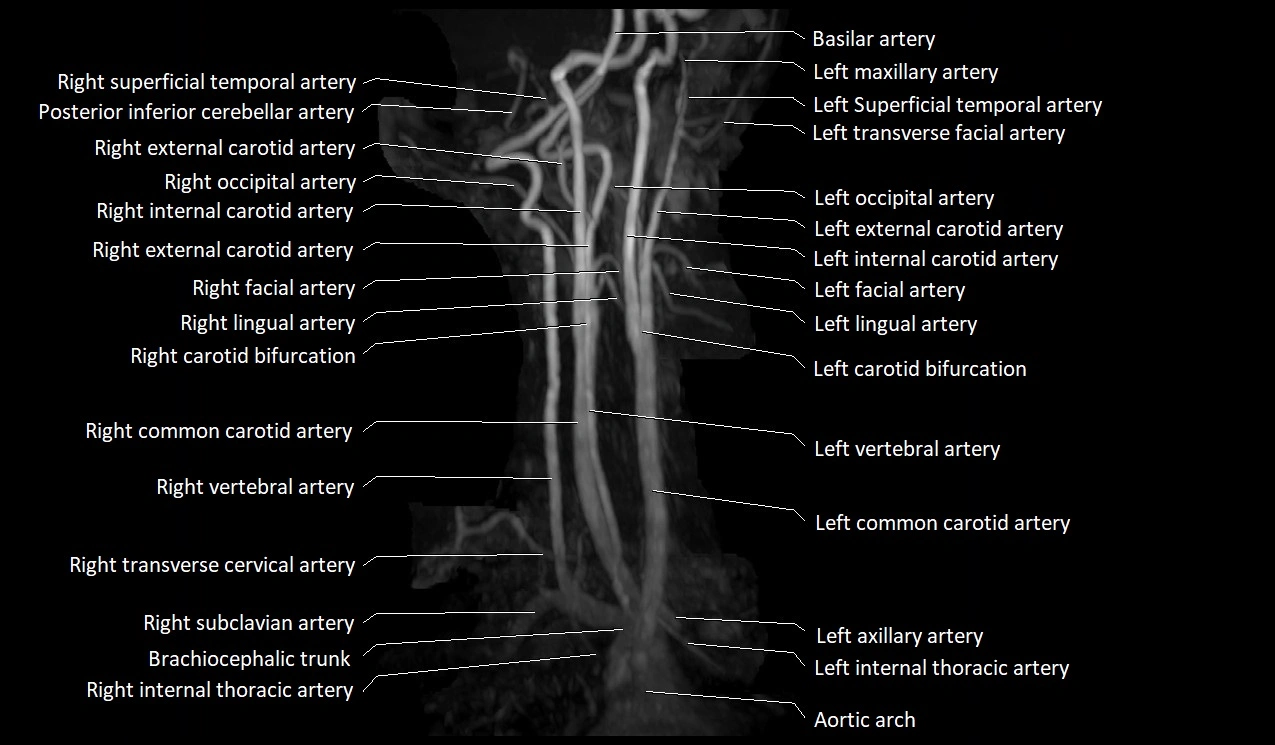 MRA neck carotid arteries labeled anatomy image MIP 3D image 10.webp